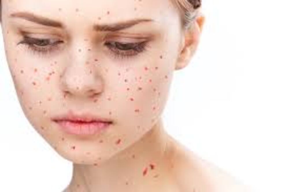 What causes chickenpox disease (चेचक) - संकेत और लक्षण, कारण और उपचार, के उपाय